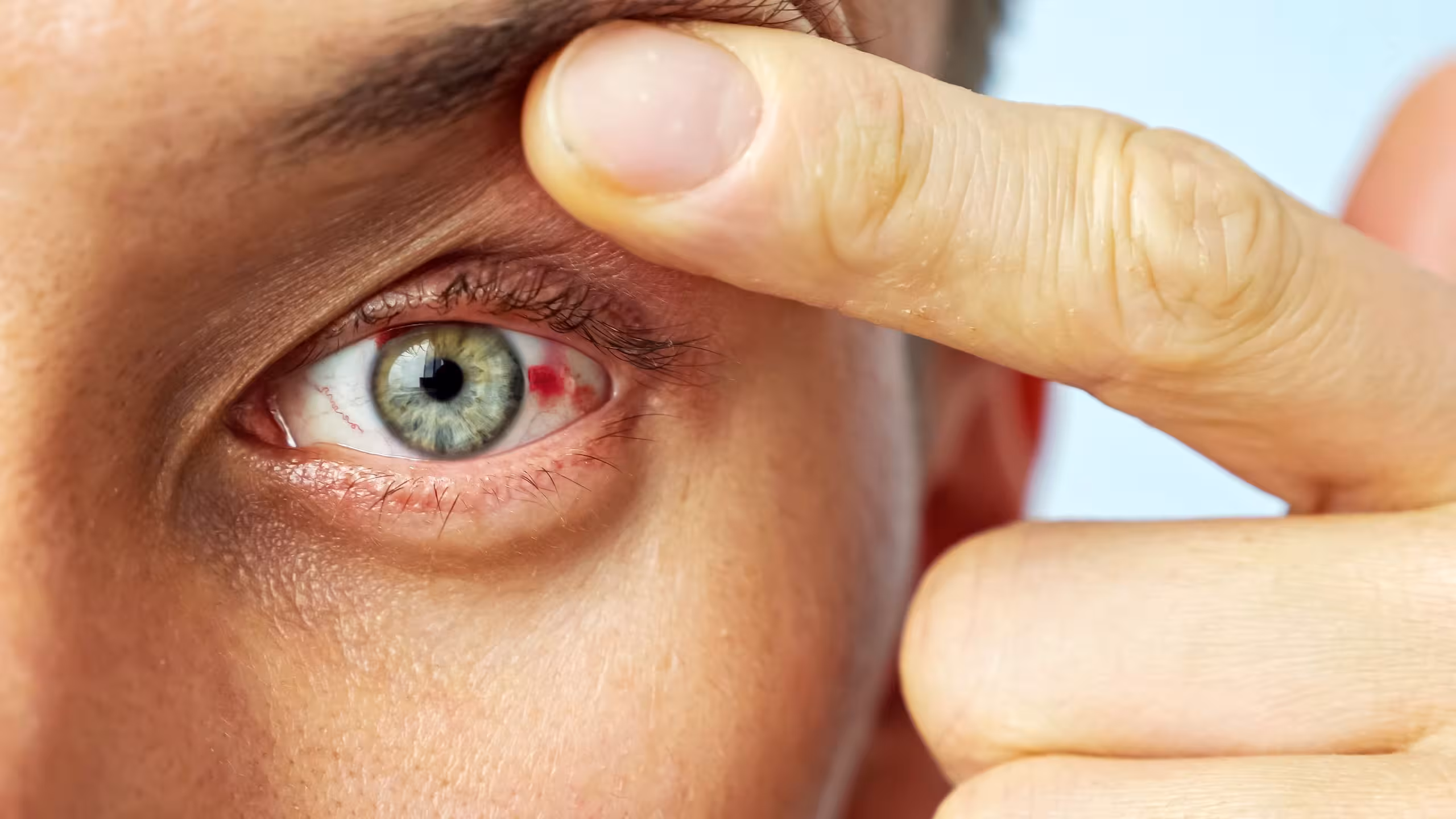 Hemorragia Subconjuntival