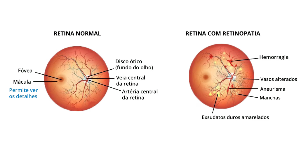 Sinais Oculares de Hipertensão na Consulta de Optometria