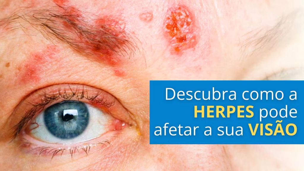 Descubra como a Herpes-Zóster pode afetar a sua saúde ocular