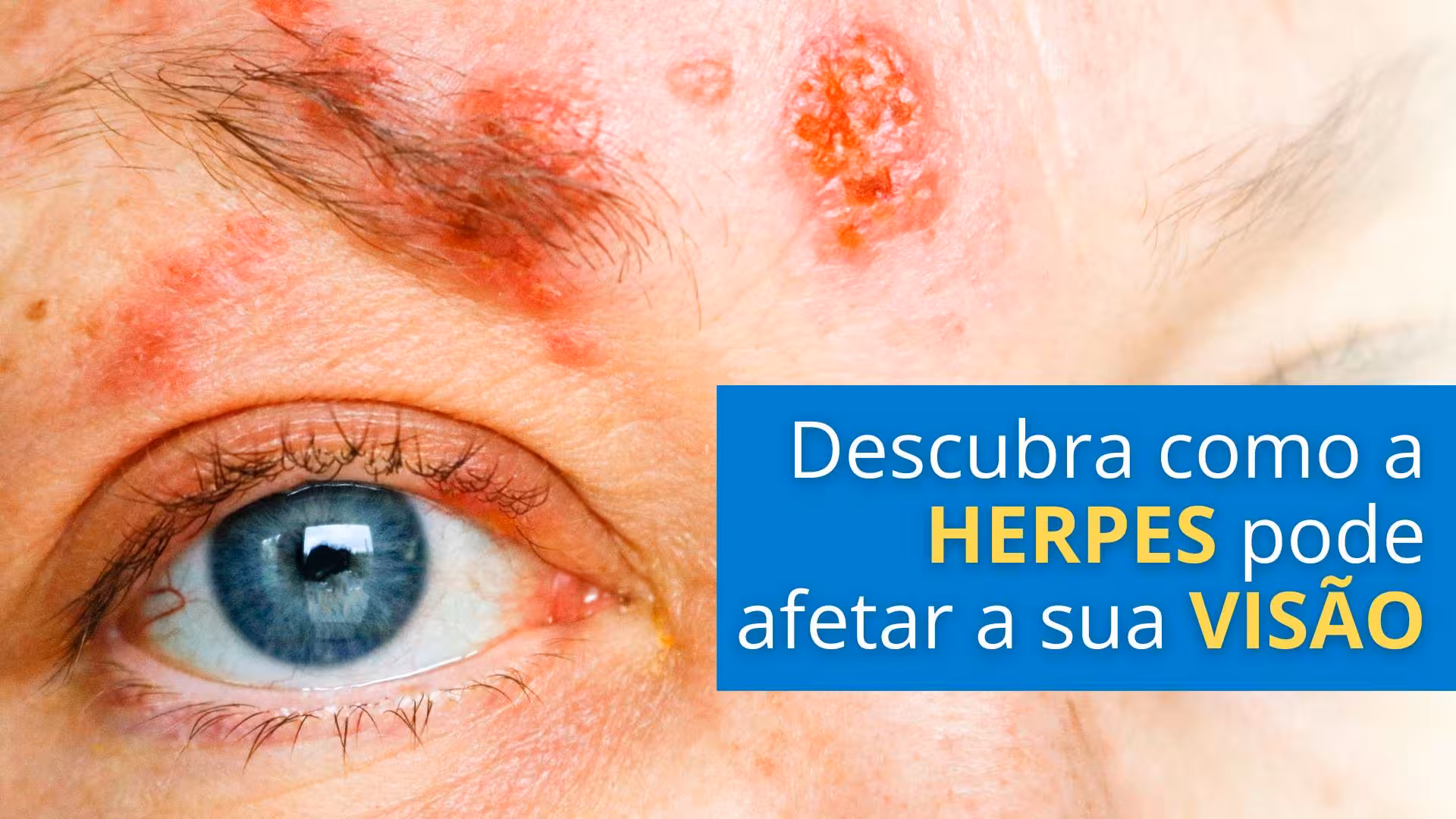 Descubra como a Herpes-Zóster pode afetar a sua saúde ocular