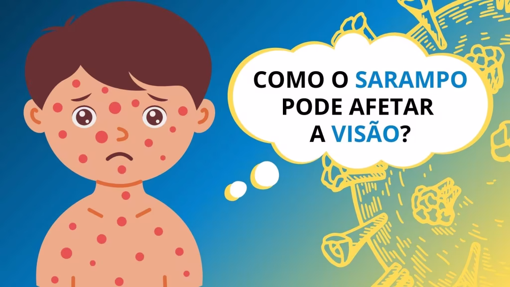 Sarampo e as suas complicações podem afetar a saúde visual