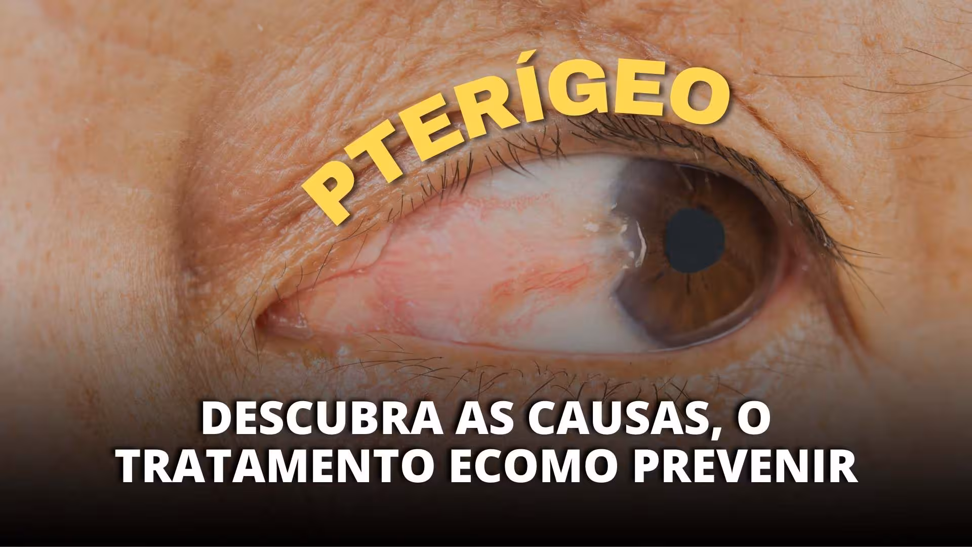 Pterígeo: descubra as causa, os tratamentos e como prevenir