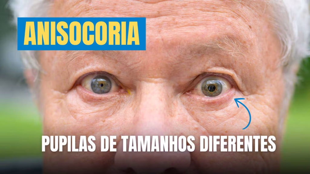 Anisocoria - Pupilas de tamanhos diferentes