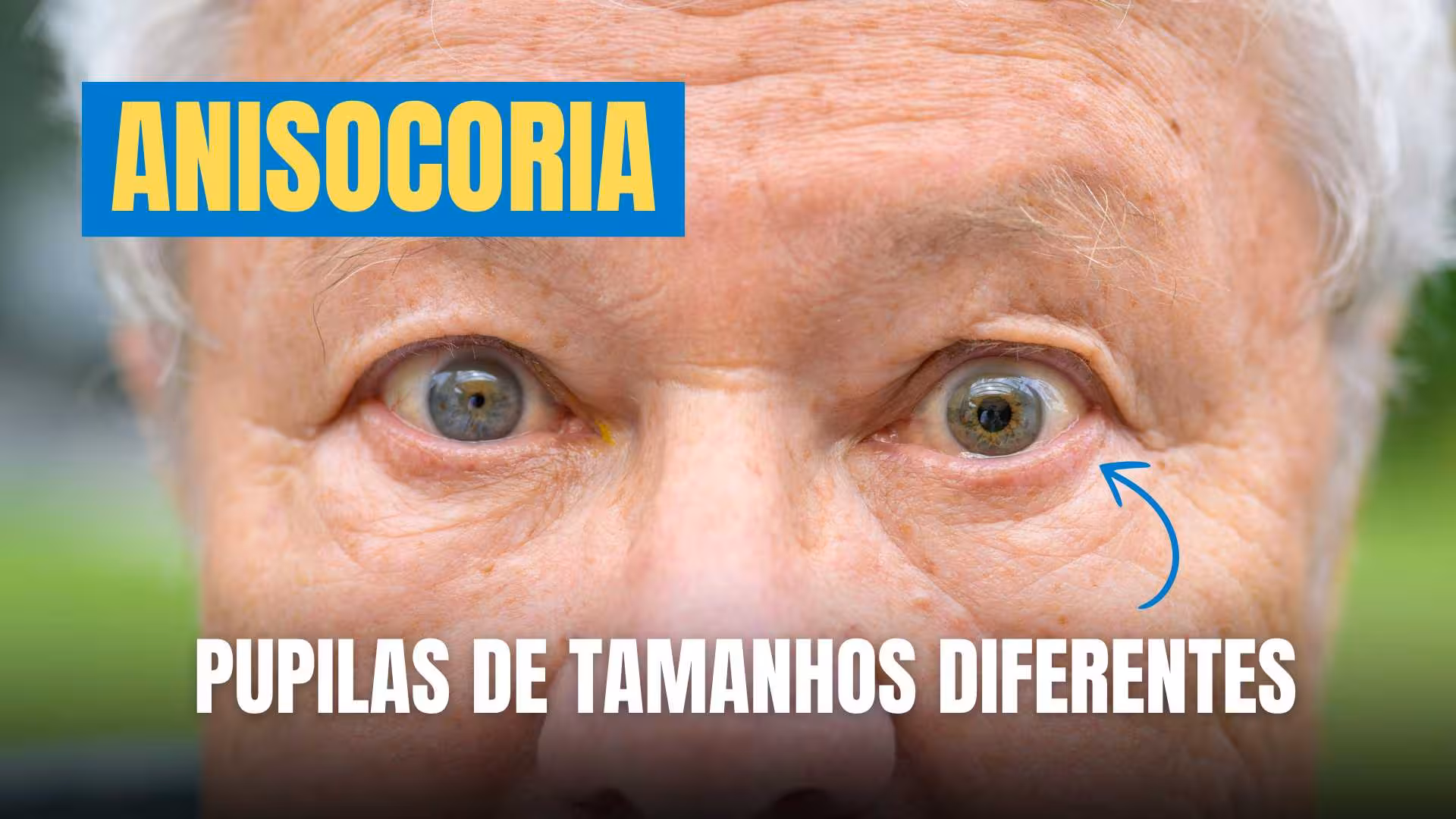 Anisocoria - Pupilas de tamanhos diferentes