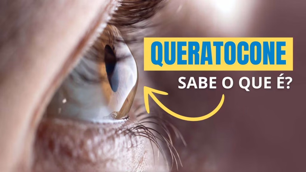 Queratocone: Causas, Sintomas e Tratamentos