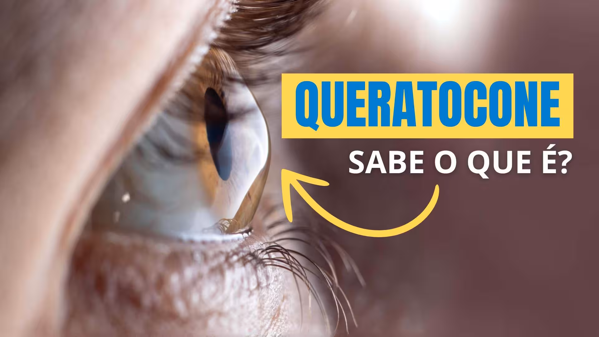 Queratocone: Causas, Sintomas e Tratamentos